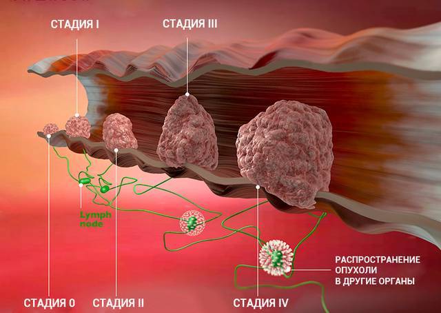 Что такое рак прямой кишки?
